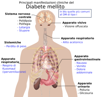 /images/5f944c2219767b03185f97d6-350px-Principali_manifestazioni_cliniche_diabete.png